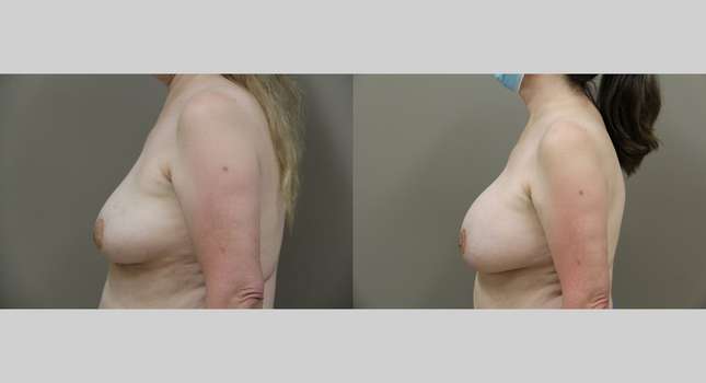 Breast Augmentation: Image #823