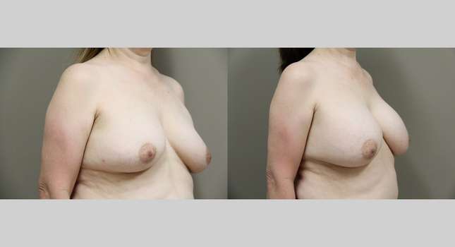 Breast Augmentation: Image #824