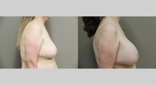 Breast Augmentation: Image #825