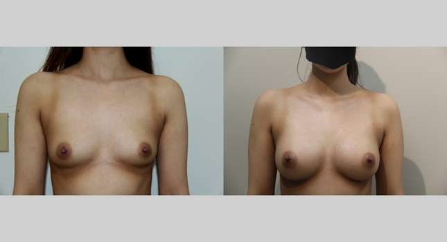 Breast Augmentation: Image #826