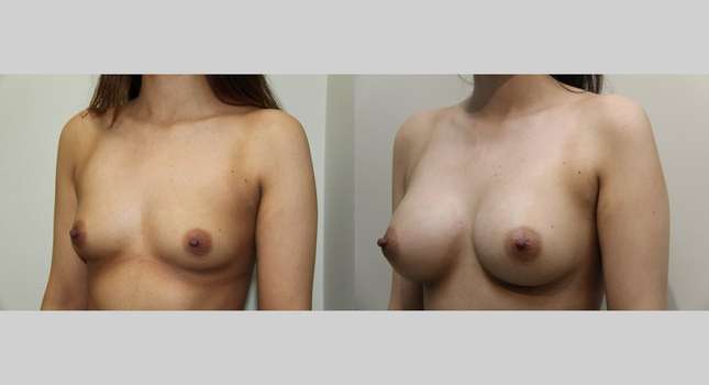 Breast Augmentation: Image #827