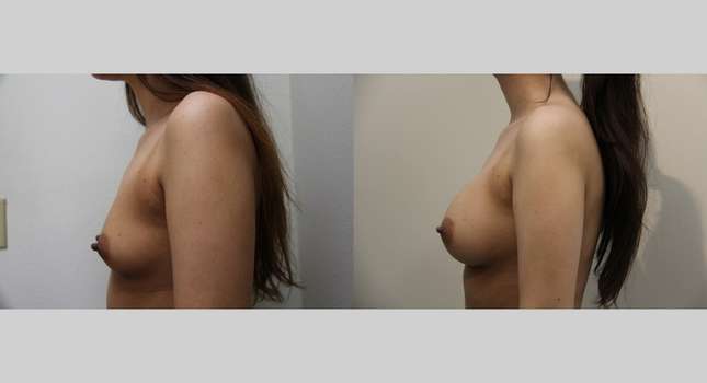 Breast Augmentation: Image #828