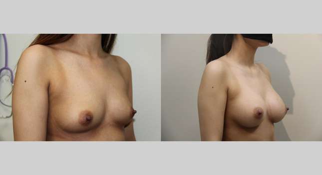 Breast Augmentation: Image #829