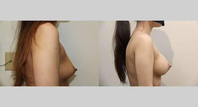 Breast Augmentation: Image #830