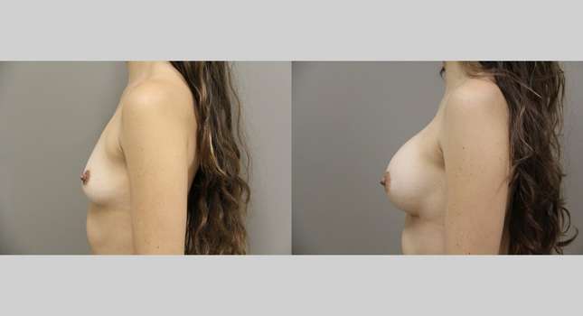 Breast Augmentation: Image #853