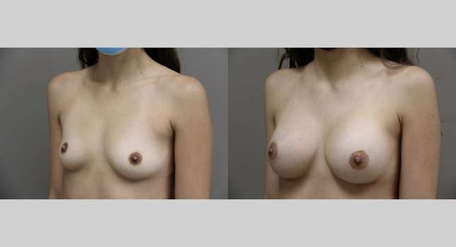 Breast Augmentation: Image #854