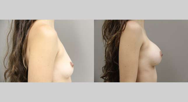 Breast Augmentation: Image #855