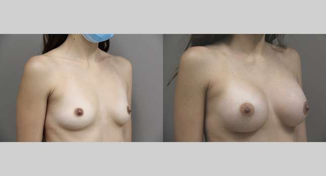 Breast Augmentation: Image #856