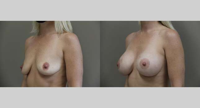 Breast Augmentation: Image #898