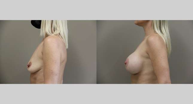 Breast Augmentation: Image #899