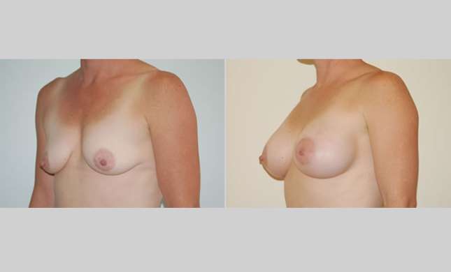 Breast Augmentation: Image #9