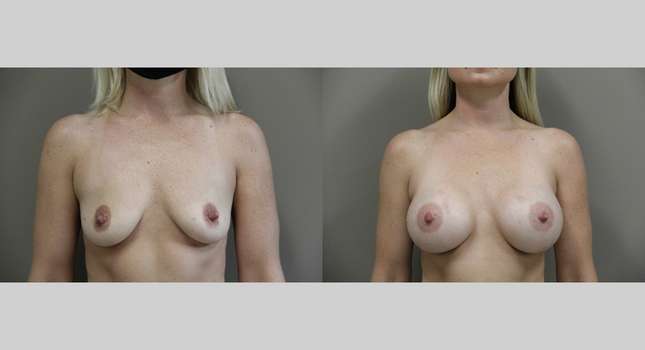 Breast Augmentation: Image #900