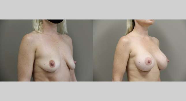 Breast Augmentation: Image #901