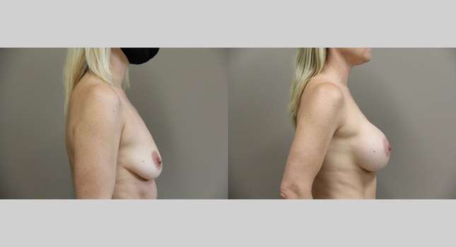 Breast Augmentation: Image #902