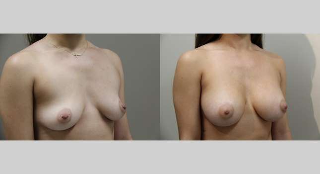 Breast Augmentation: Image #903
