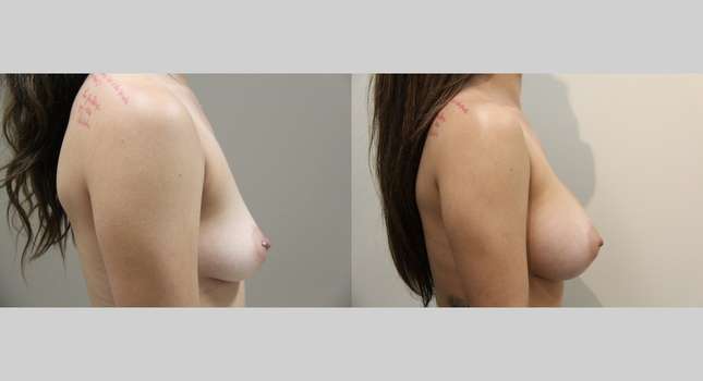 Breast Augmentation: Image #904