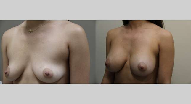 Breast Augmentation: Image #905
