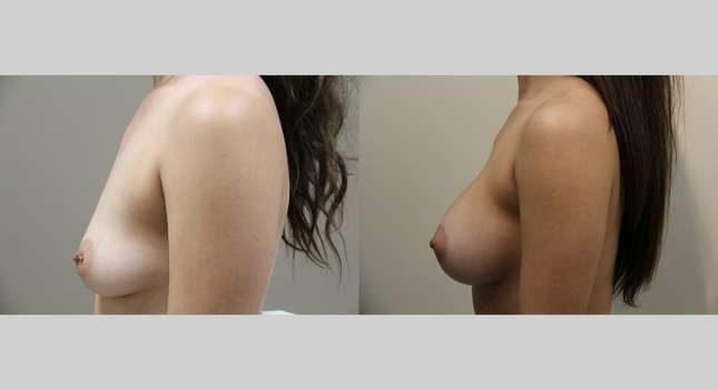 Breast Augmentation: Image #906