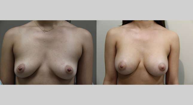 Breast Augmentation: Image #907
