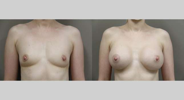 Breast Augmentation: Image #912