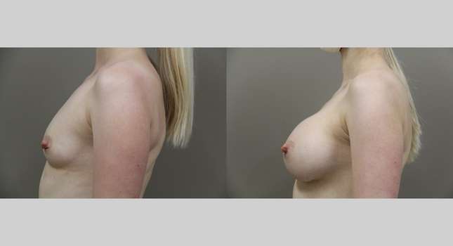 Breast Augmentation: Image #913