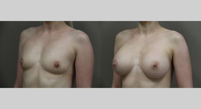 Breast Augmentation: Image #914