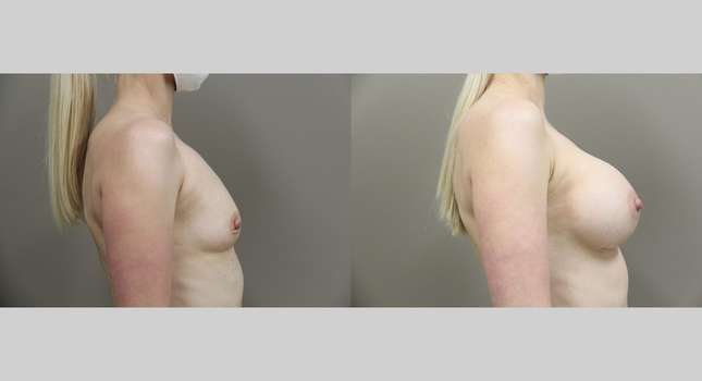 Breast Augmentation: Image #915
