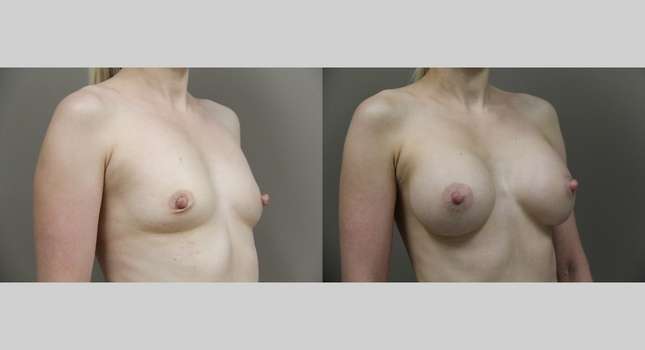 Breast Augmentation: Image #916