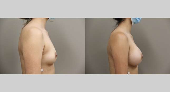 Breast Augmentation: Image #951