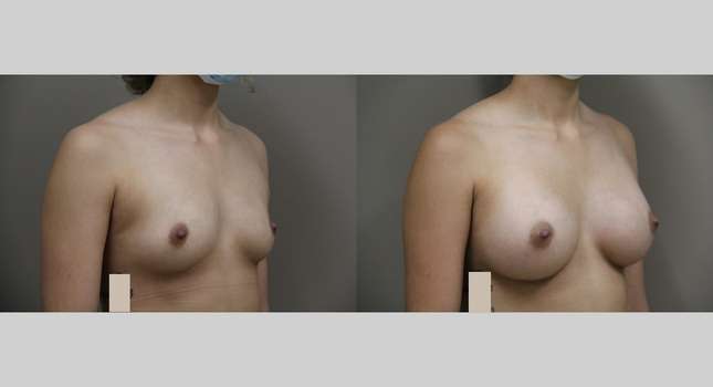 Breast Augmentation: Image #952