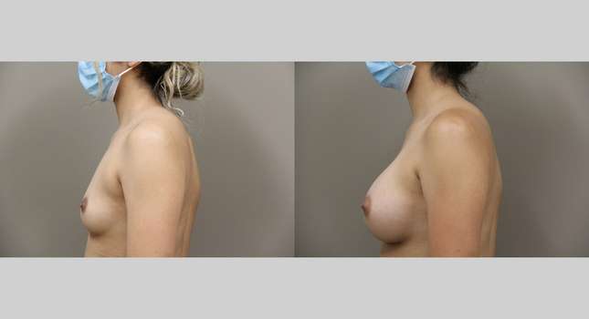 Breast Augmentation: Image #953