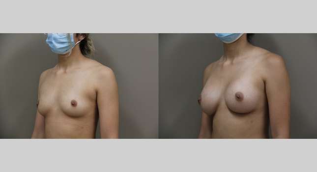 Breast Augmentation: Image #954