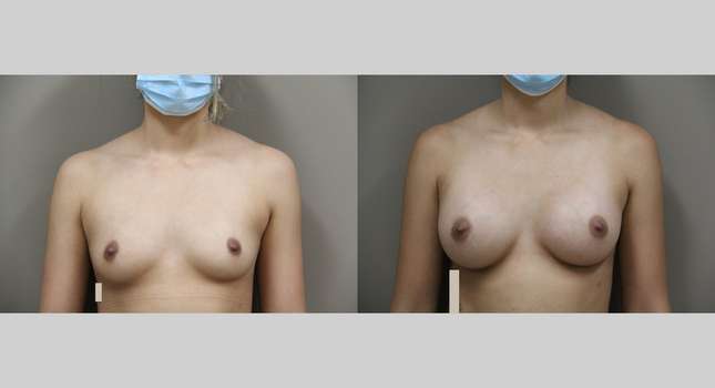 Breast Augmentation: Image #955