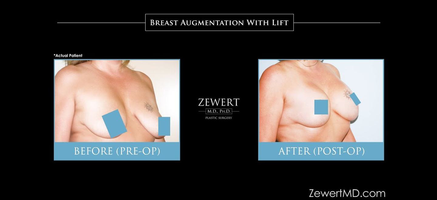 Breast Lift