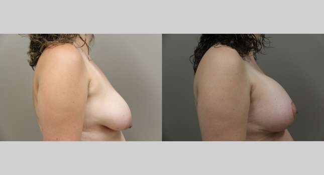 Breast Lift: Image #1120