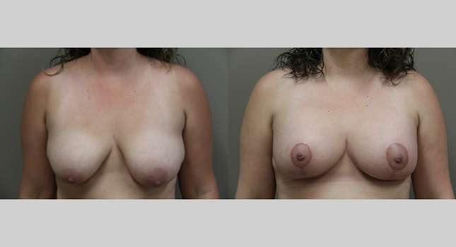 Breast Lift: Image #1124