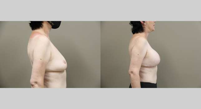 Breast Lift: Image #1271