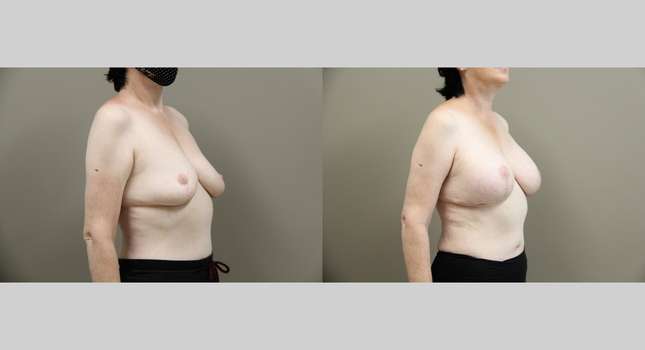 Breast Lift: Image #1272