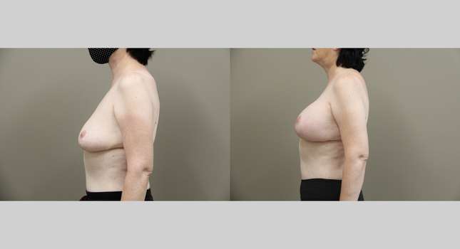 Breast Lift: Image #1277