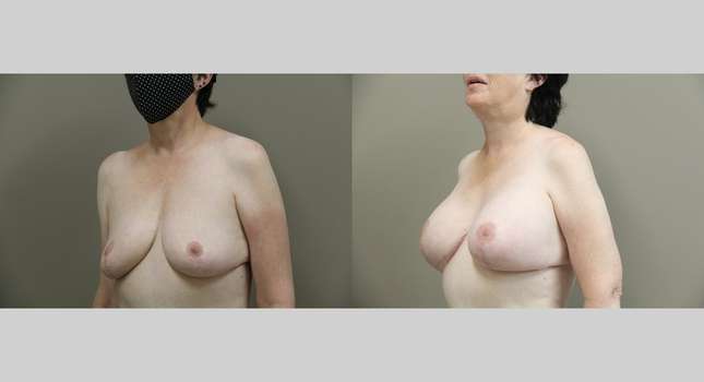 Breast Lift: Image #1278