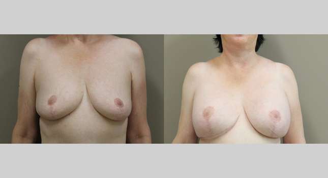 Breast Lift: Image #1279