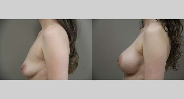 Breast Augmentation: Image #1314