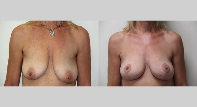 Breast Lift: Image #400