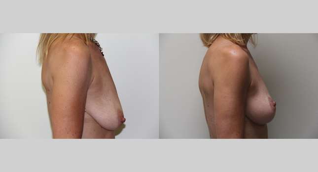 Breast Lift: Image #401