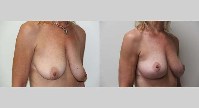 Breast Lift: Image #402