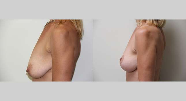 Breast Lift: Image #403