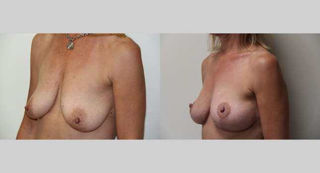 Breast Lift: Image #404