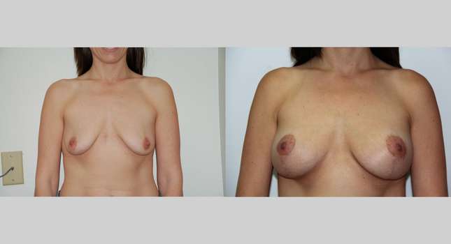 Breast Lift: Image #405