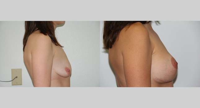 Breast Lift: Image #406