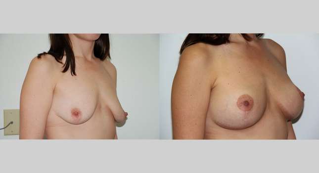 Breast Lift: Image #407